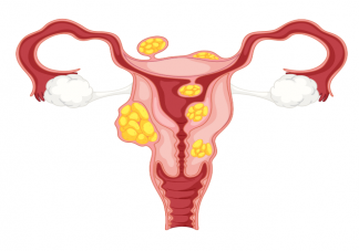 为什么卵巢癌被称为妇癌之王 卵巢癌会反复复发吗