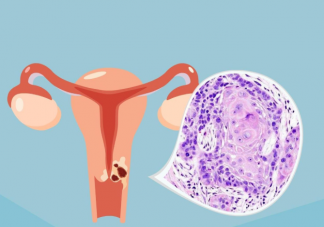卵巢癌的高发人群是哪些 如何减少卵巢癌的发生