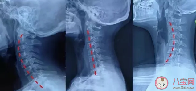 怎么判断自己有没有颈椎反弓 如何预防颈椎反弓
