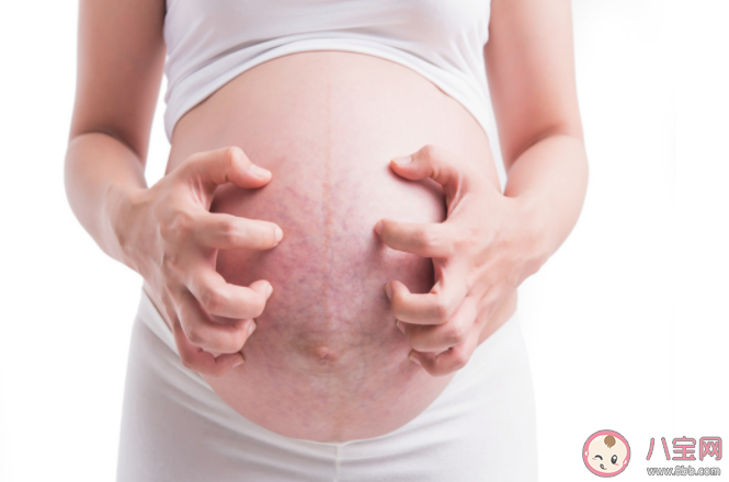 怀孕妊娠纹很痒怎么缓解 孕期妊娠纹为什么会痒