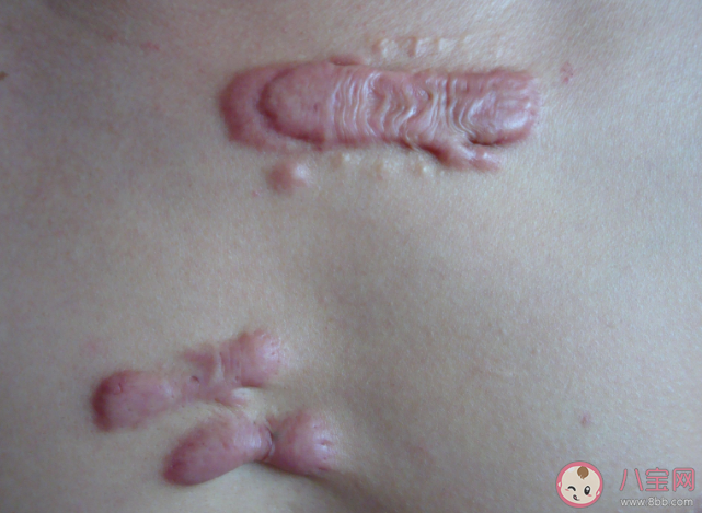 哪些症状可能是疤痕癌变 如何预防疤痕癌变