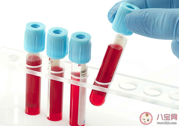 血液生化21项都要做吗 血液生化检查前做哪些让检查结果更准确