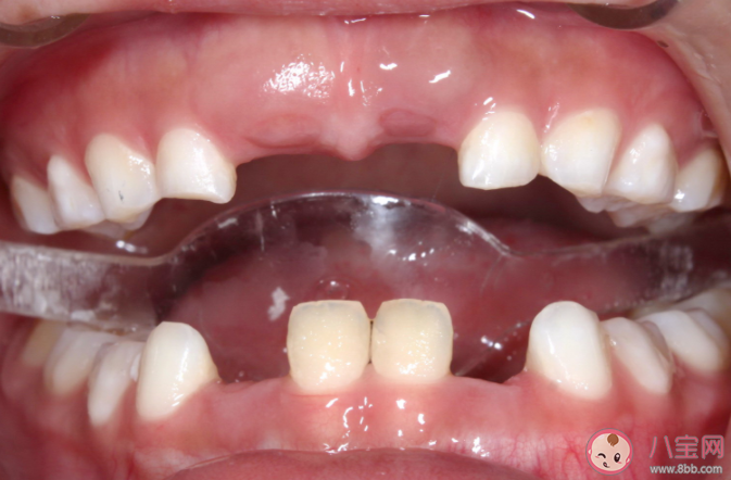儿童哪些牙齿最容易受伤 儿童牙外伤需要做哪些检查