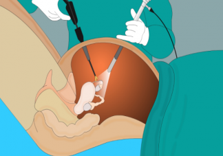 做宫腔镜检查会影响生育吗 什么时候做宫腔镜效果最好