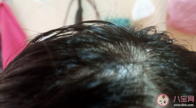 ​为什么头发油的特别快 头发油腻有什么方法改善