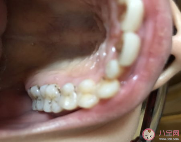 牙齿有黑缝可能是蛀牙了吗 黑缝是如何产生的