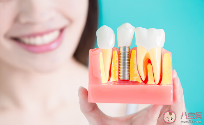 为什么种植牙那么贵 种植牙的优点好处是什么