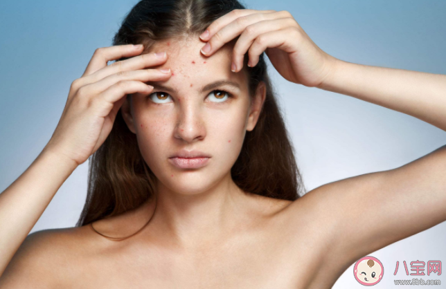 油性皮肤优缺点是什么 油性皮肤如何去除脸上的痘痘