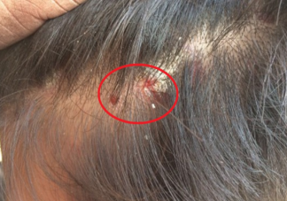 头皮上抠下的小颗粒是什么 如何正确护理头皮