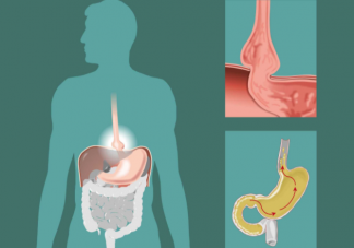 胃食管反流病为什么一停药就复发 如何预防胃食管反流复发