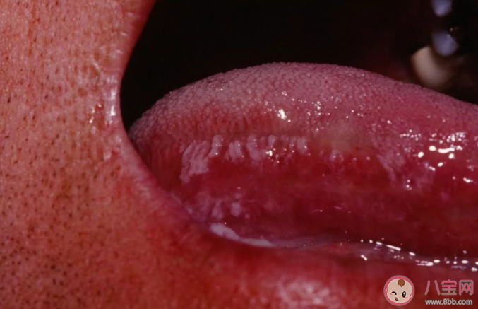 女子反复口腔溃疡确诊舌癌中晚期是怎么回事 什么的口腔溃疡可能是口腔癌