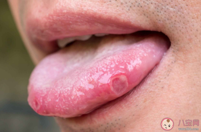 女子反复口腔溃疡确诊舌癌中晚期是怎么回事 什么的口腔溃疡可能是口腔癌