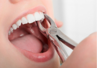 医生建议上午拔牙的原因是什么 哪几类人群拔牙一定要谨慎