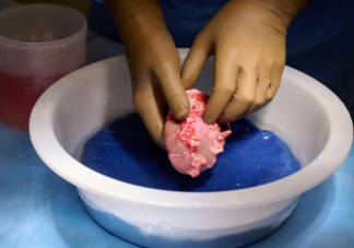 世界首例猪肾脏移植人体手术成功 猪移植肾脏为什么能够成功