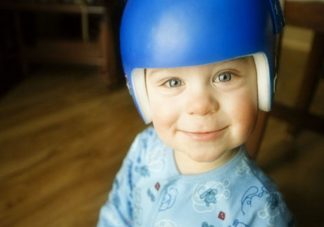 头型矫正头盔真的有用吗 婴儿头型矫正有必要吗