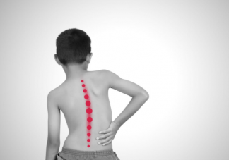 脊柱侧弯容易在什么年龄阶段被发现 脊柱侧弯早期症状有哪些