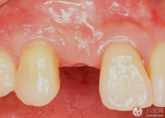 拔牙后的洞一直塞食物怎么办 拔牙后的牙洞多久能长好