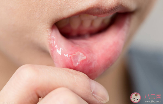 为什么冬季容易口腔溃疡 口腔溃疡的快速止痛法