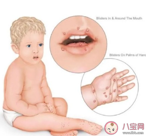 手足口高发期孩子应该如何防范 手足口病是什么原因引起的