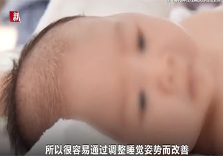 网红矫正头盔或影响婴儿发育 定型枕定型头盔有用吗