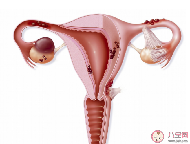 有卵巢囊肿可以怀孕吗 没有性生活也会得卵巢囊肿吗