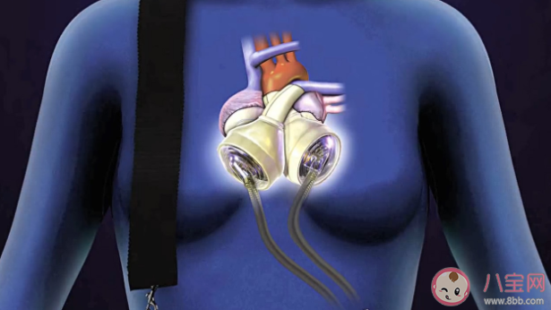男子植入人工心脏需每天充电 人工心脏断电会怎样