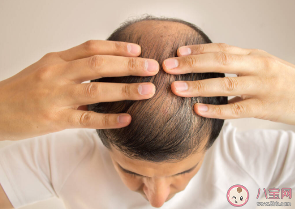每天掉多少头发是病理性脱发 这10种情况脱发会找上门