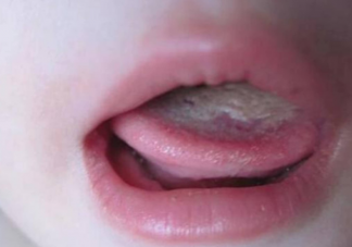 孩子舌苔厚会引起口臭吗 宝宝舌苔又厚又白是什么原因