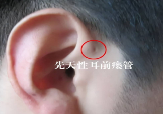 宝宝耳朵上的小孔是什么 耳前瘘管有什么危害