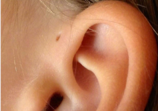 宝宝有耳前瘘管会影响听力吗 耳前瘘管日常如何护理