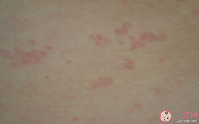 什么季节容易长湿疹 做好哪些事能有效预防湿疹