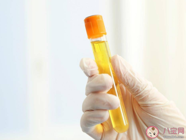常用尿酸检查方法有哪些 尿酸需要反复检查吗