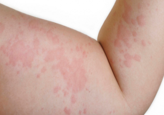 为什么春天容易皮肤过敏 长湿疹和湿气有关系吗