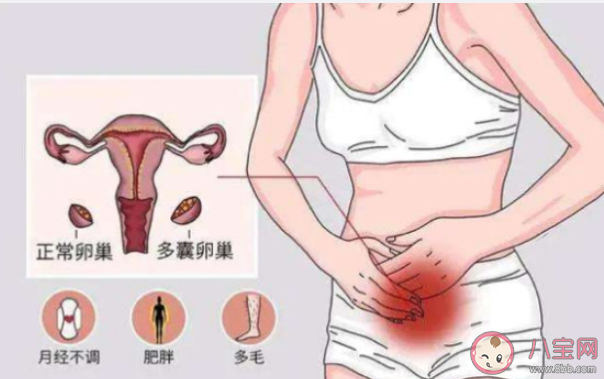 多囊卵巢综合症|多囊卵巢综合症有多隐蔽 该如何应对多囊卵巢综合症