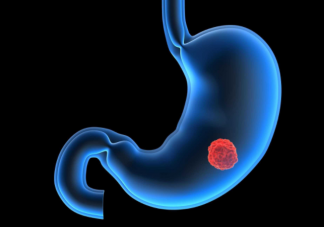 哪些是胃癌高危因素 感染幽门螺杆菌就一定会引起胃癌吗