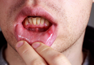 危险的口腔溃疡长什么样 口腔溃疡的常见并发症有哪些