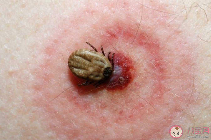 蜱虫|在身上发现了蜱虫该怎么处理 蜱虫叮咬预防建议