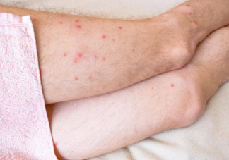荨麻疹可以治好不复发吗 荨麻疹的病因有哪些