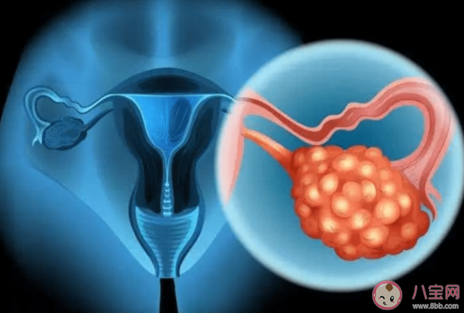 约70%卵巢癌患者确诊已是晚期 为什么卵巢癌难以发现