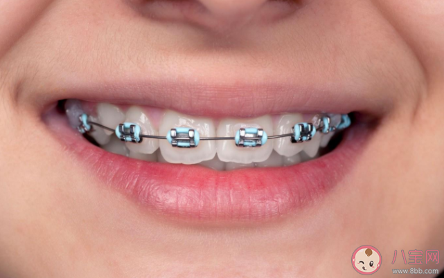 箍牙会导致牙齿松动吗 箍牙的步骤流程是怎样的