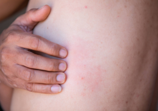 带状疱疹为什么那么痛 带状疱疹如何做好预防
