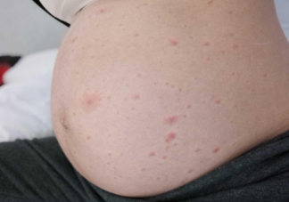 孕期长水痘对胎儿有什么影响 孕期水痘怎么处理