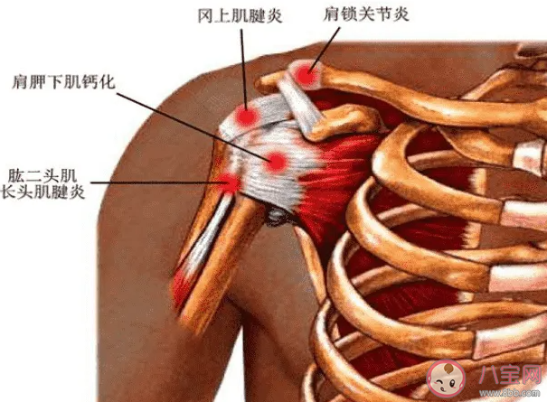 肩膀总是疼是不是患了肩周炎 肩周炎有哪些症状