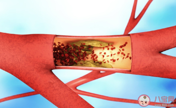 血管堵塞会对身体造成哪些危害 哪些食物易堵塞血管