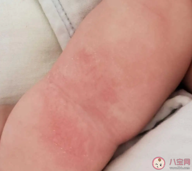 宝宝长湿疹该怎么办 有哪些预防和治疗湿疹的办法