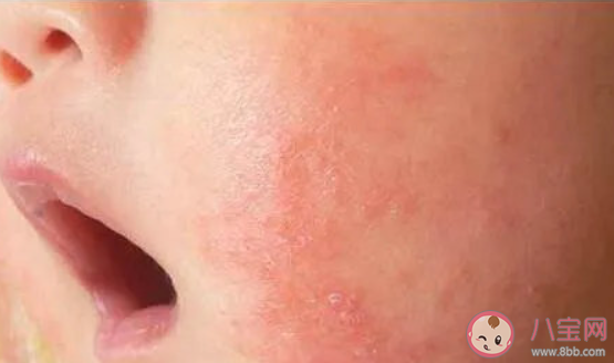 宝宝长湿疹该怎么办 有哪些预防和治疗湿疹的办法