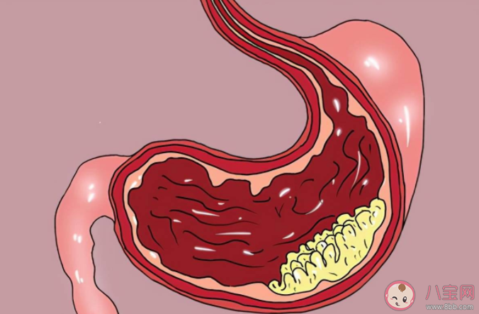胃癌容易缠上哪种血型的人 为什么A型血容易得胃癌