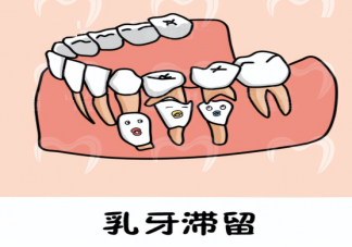乳牙滞留应该怎么处理 家长如何预防孩子乳牙滞留