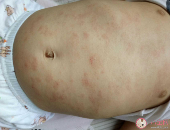 儿童特应性皮炎有什么症状 孩子出现特应性皮炎如何治疗