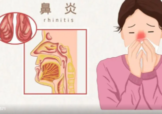 过敏性鼻炎会过度成鼻窦炎吗 过敏性鼻炎与鼻窦炎有什么不同